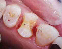 上あごの小臼歯