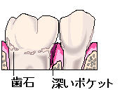 歯周ポケット