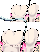  ポケット測定検査