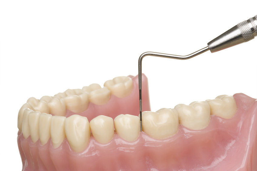 歯周病について